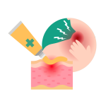 Pain relief gels & topical steroids